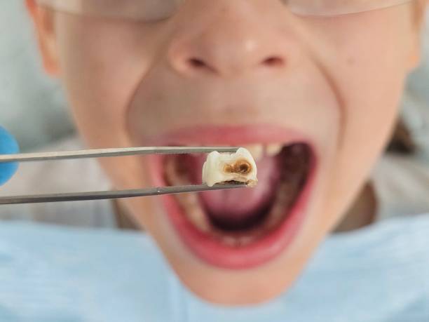 Best Emergency Dentist for Knocked-Out Tooth in Montrose, NY